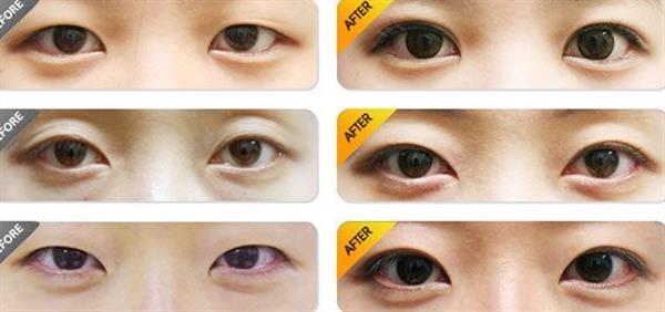 <a href=http://www.bolangguoji.com/listinfo-724-0.html target=_blank class=infotextkey>雙眼皮</a>埋線恢復(fù)過程圖效果對比