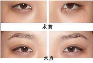 割<a href=http://www.bolangguoji.com/listinfo-724-0.html target=_blank class=infotextkey>雙眼皮</a>后用什么冷敷