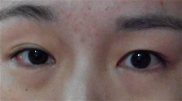 眼袋大原因是什么進行治療會有效嗎