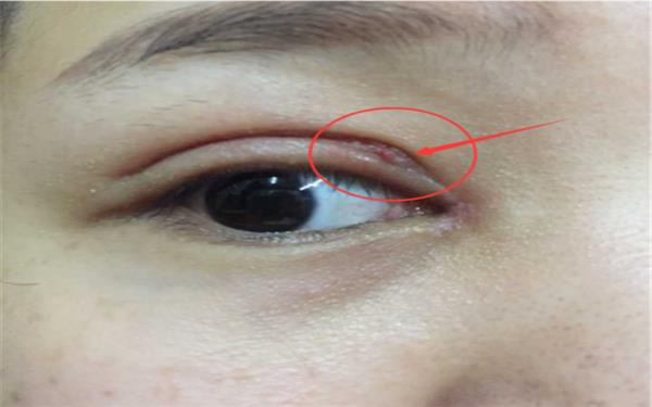 <a href=http://www.bolangguoji.com/listinfo-724-0.html target=_blank class=infotextkey>雙眼皮</a>增生怎么好得快