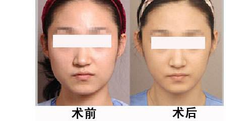 學生<a href=http://www.bolangguoji.com/listinfo-631-0.html target=_blank class=infotextkey>瘦臉</a>的較好方法