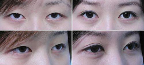 廣州<a href=http://www.bolangguoji.com/listinfo-724-0.html target=_blank class=infotextkey>雙眼皮</a>多少錢
