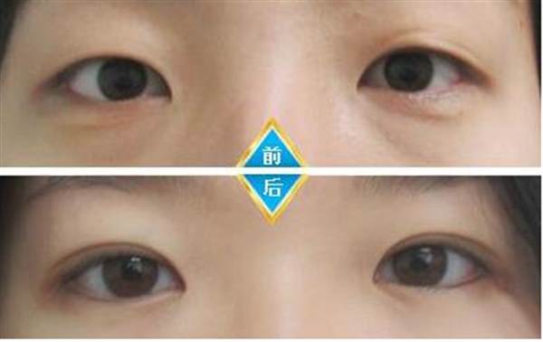 上海哪里可以<a href=http://www.bolangguoji.com/listinfo-711-0.html target=_blank class=infotextkey>開(kāi)眼角</a>